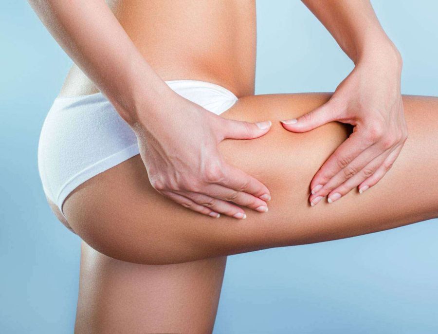cellulite