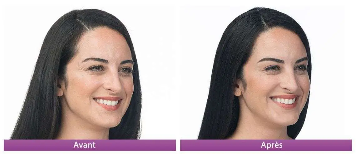 botox avant apres 1 gauche