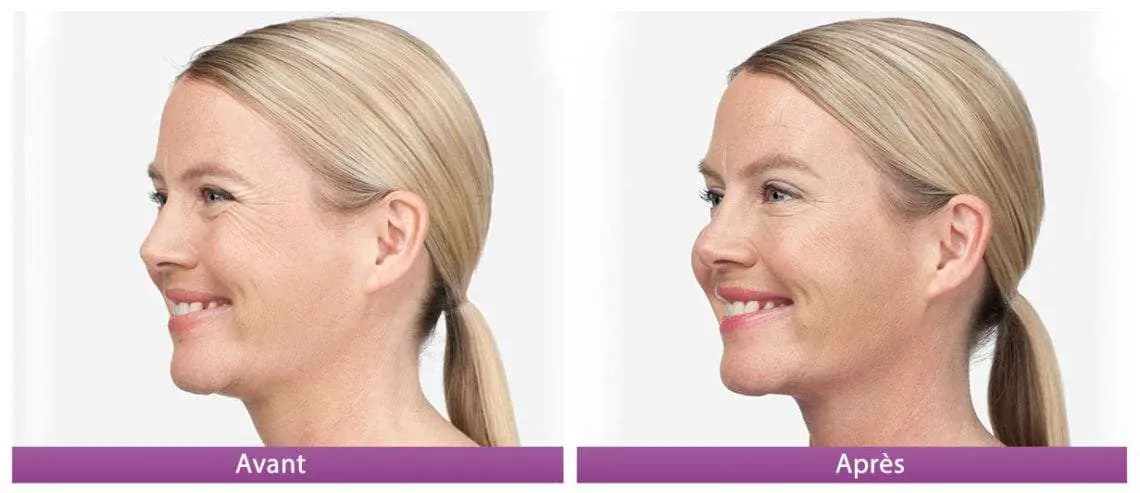 botox avant apres 2 droite