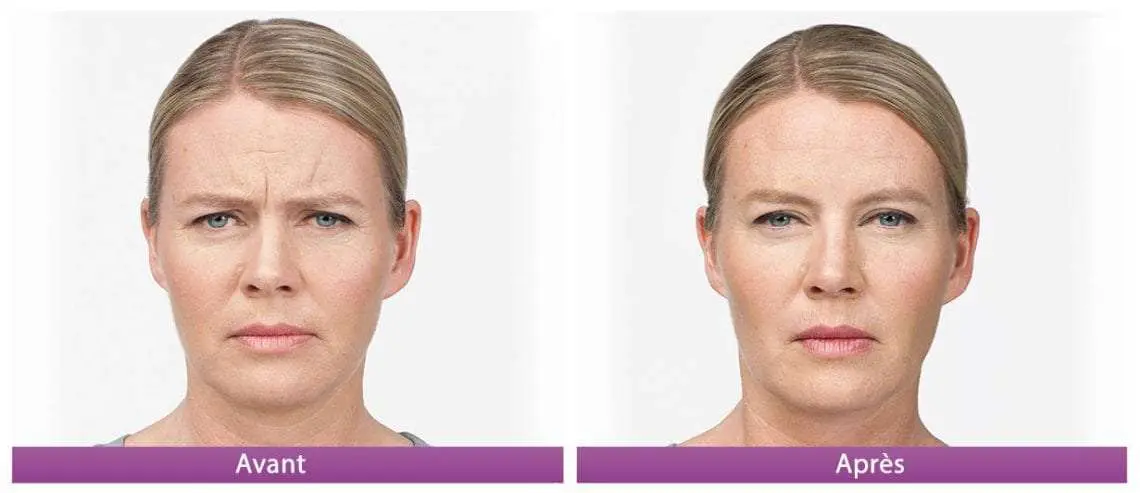 botox avant apres 2 front