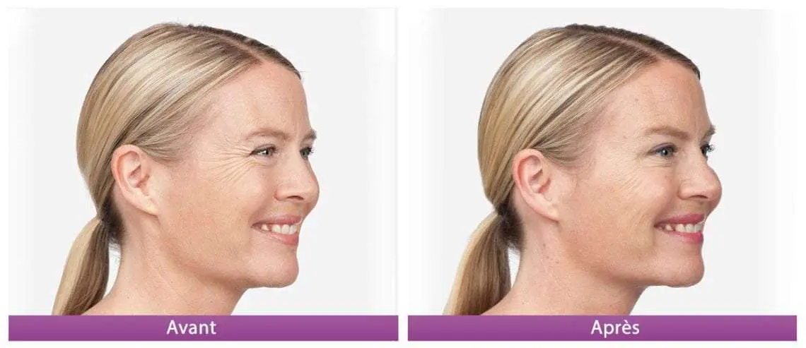 botox avant apres 2 gauche