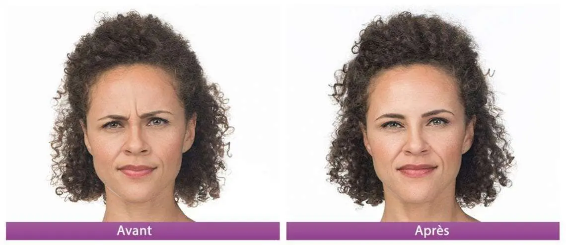 botox avant apres 3 front