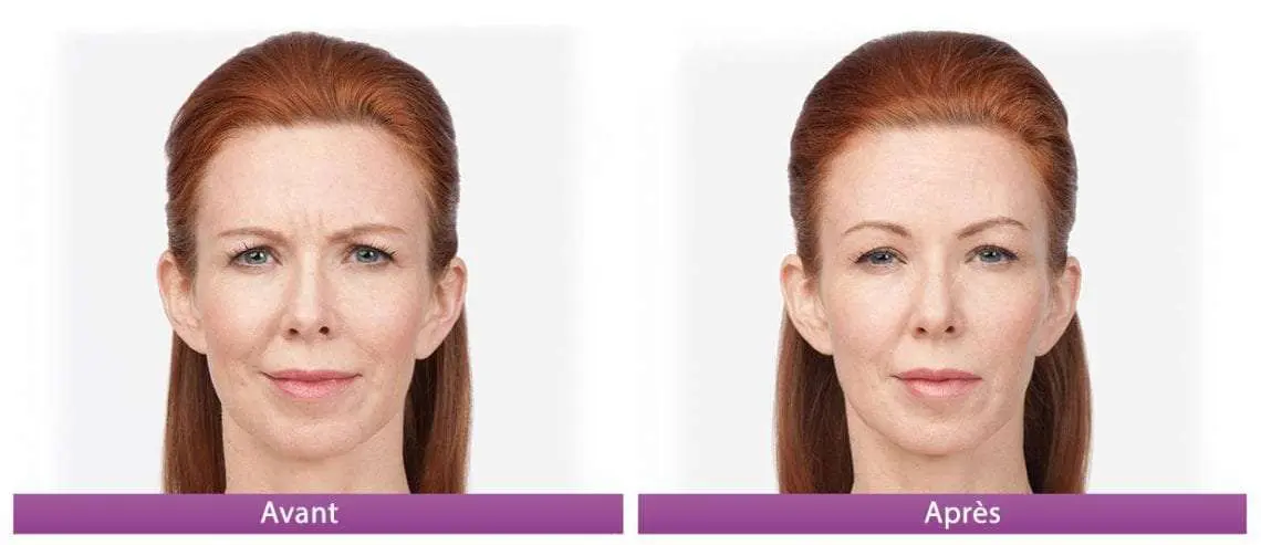 botox avant apres 4 front