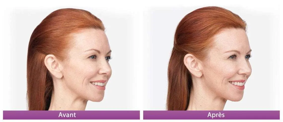 botox avant apres 4 gauche