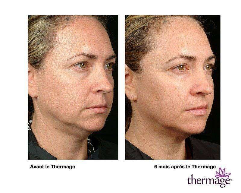 thermage